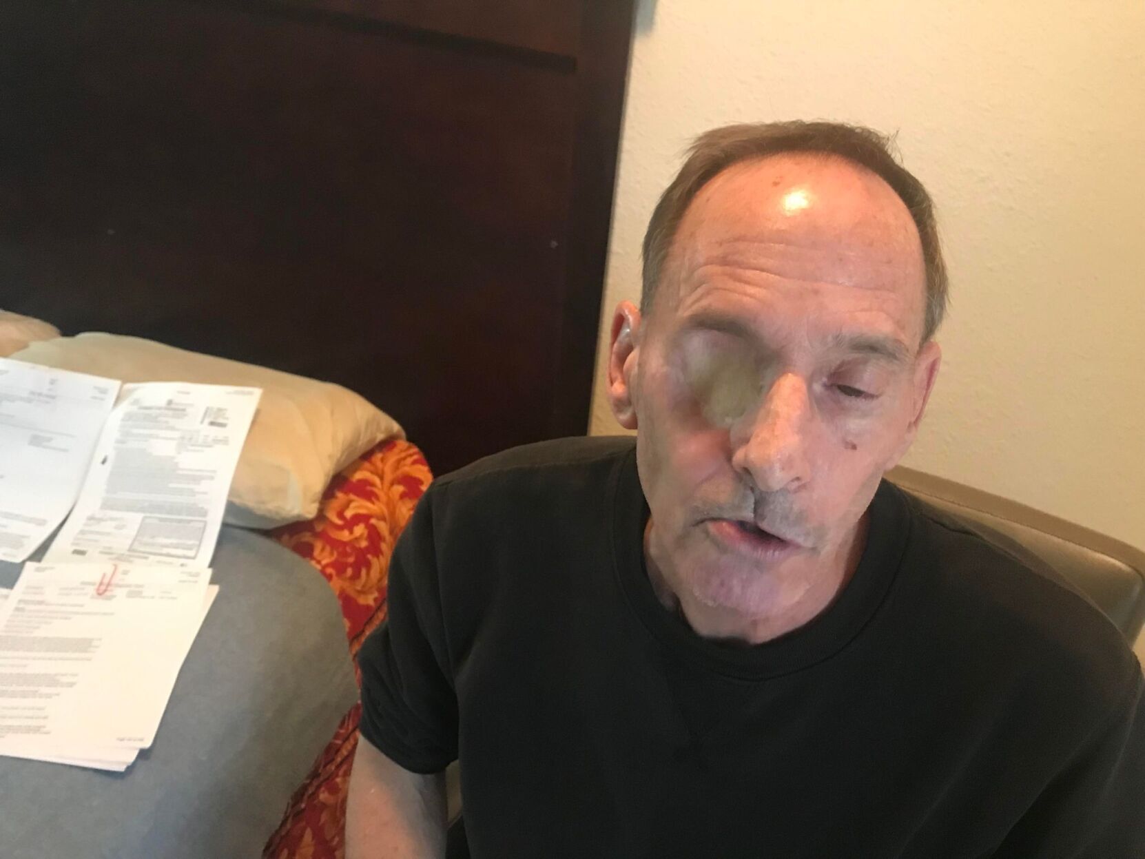 Cancer survivor wakes up from surgery without his right eye and confused by multiple scars